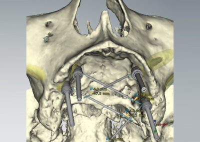 Implantes en hueso cigomático